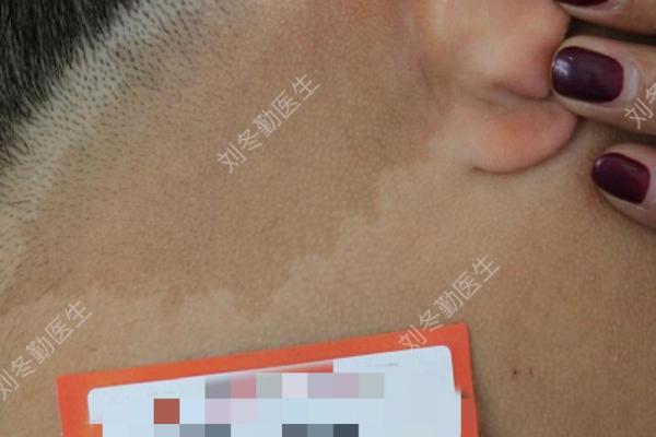 脖子上的胎记算命