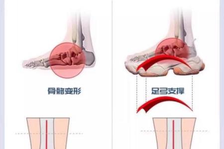 八字腿矫正