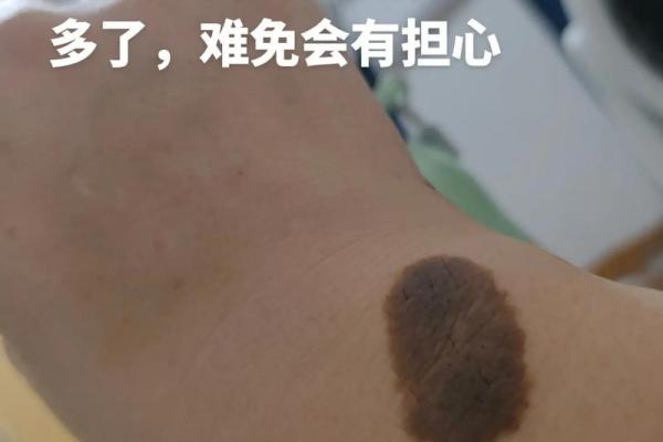 胎记算命：最好胎记长什么部位