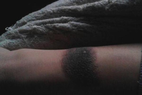 黑色胎记算命分析 黑色胎记算命分析