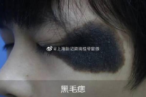 黑色胎记算命分析 黑色胎记算命分析