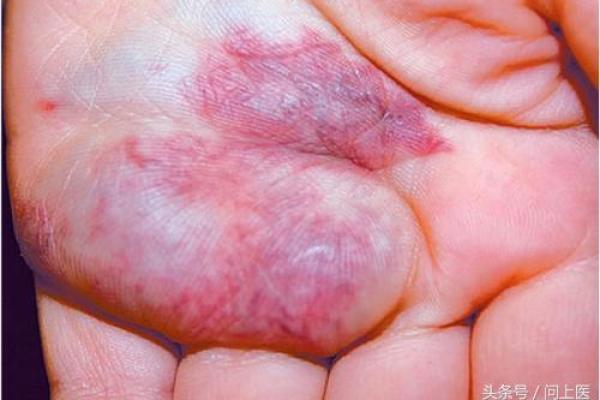 手臂上的胎记算命图解