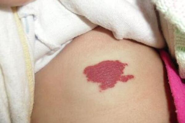 手臂上的胎记算命图解