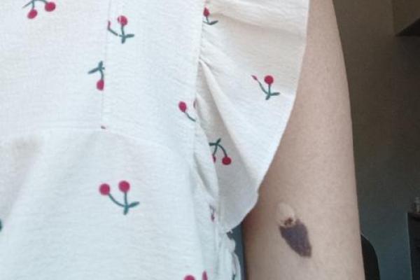 胳膊胎记可以算命吗-