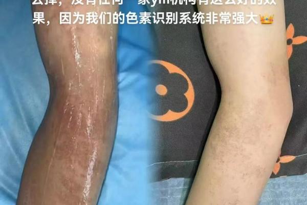 胳膊胎记可以算命吗-