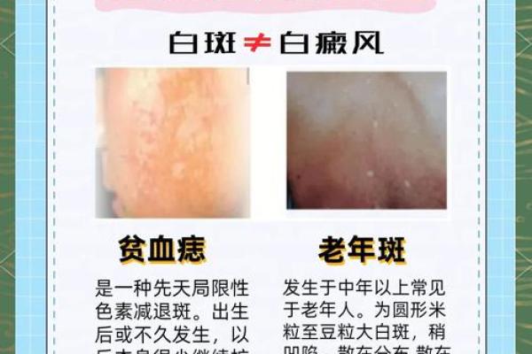 白色胎记算命分析 白色胎记算命分析