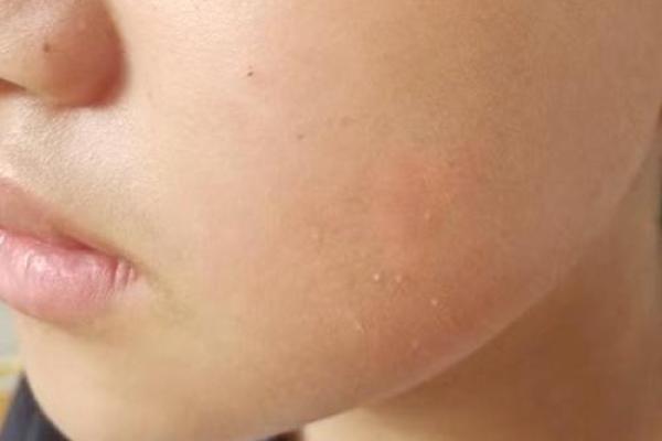 面部不同位置的胎记算命