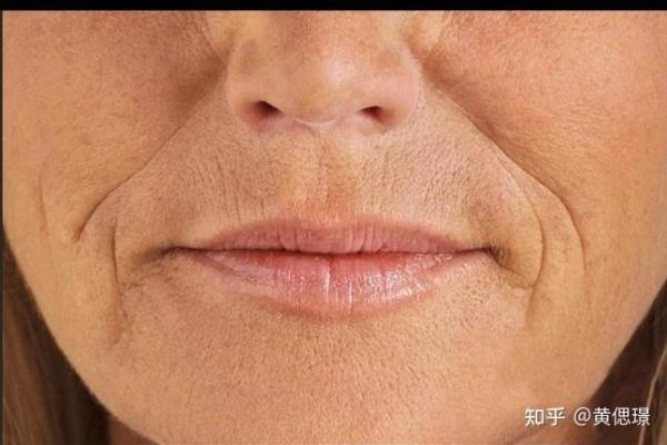 嘴巴八字纹