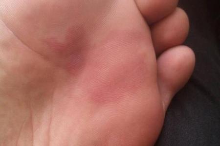 胎记释义，胎记算命中代表什么