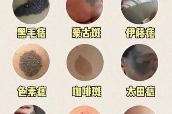 胎记算命图解：什么是红胎记？