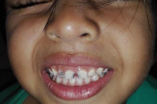 八字牙图片 八字牙图片