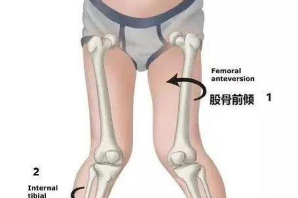 怎样纠正内八字,14岁内八字怎么矫正最快 怎样纠正内八字,14岁内八字怎么矫正最快