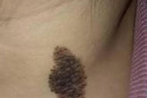 脖子上的胎记如何算命-