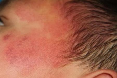 红色胎记算命分析